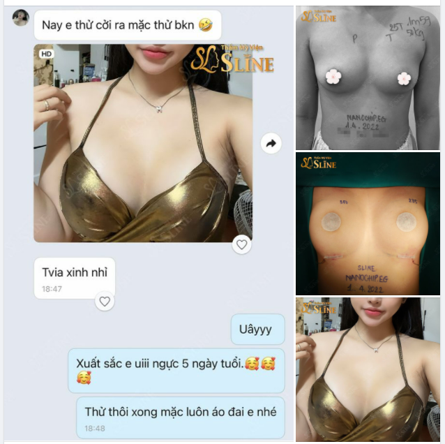 Ngực sau 5 ngày tuổi sẽ như thế này đây.