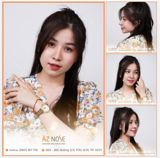 Nhà em ai cũng khen nâng mũi xong nhìn xinh hơn