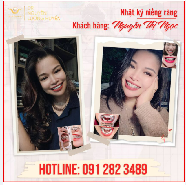 NHẬT KÝ NIỀNG RĂNG KHÔNG NHỔ RĂNG