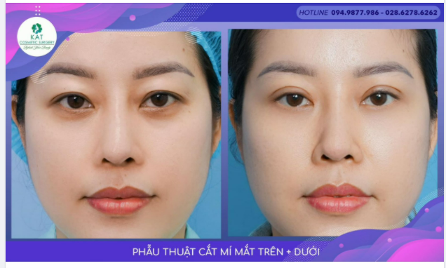 Nhiều khách hàng đến với KAT và nói rằng mắt chị lúc nào cũng trông mệt mỏi thiếu sức sống dù chị vẫn đang rất vui vẻ khoẻ mạnh. Vì sao ​​​​​​​