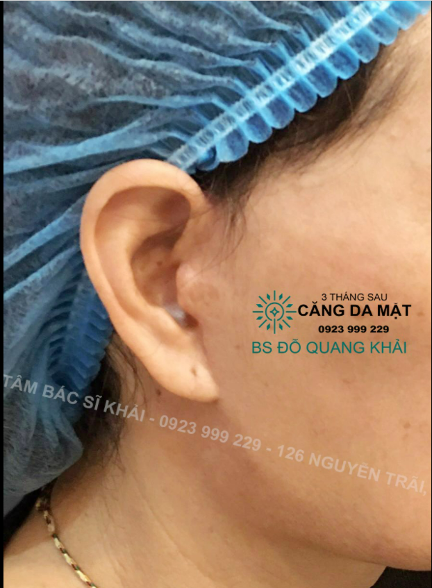 NHÌN HÌNH - ĐOÁN VỊ TRÍ SẸO CĂNG DA