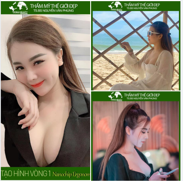 Nhìn lại kết quả vòng 1 căng mềm, quyến rũ vào form tự nhiên sau 3 năm tạo hình bằng túi nâng ngực nanochip Ergonomix