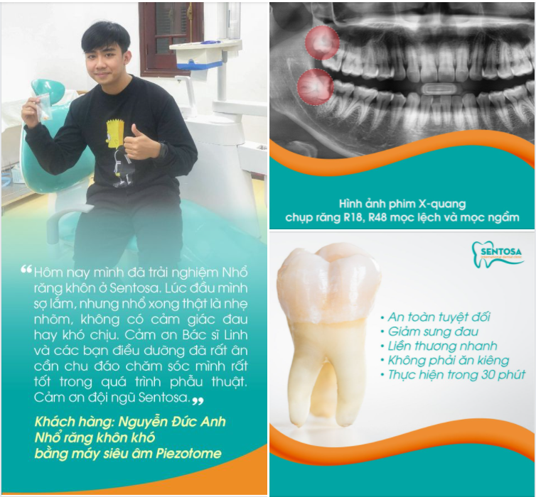 NHỔ RĂNG 8 - CHƯA BAO GIỜ NHẸ NHÀNG VÀ NHANH CHÓNG ĐẾN THẾ