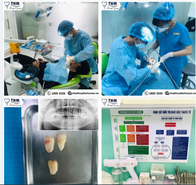 Nhổ Răng Khôn An Toàn Nhanh Chóng Tại Nha Khoa Thế Hệ Mới
