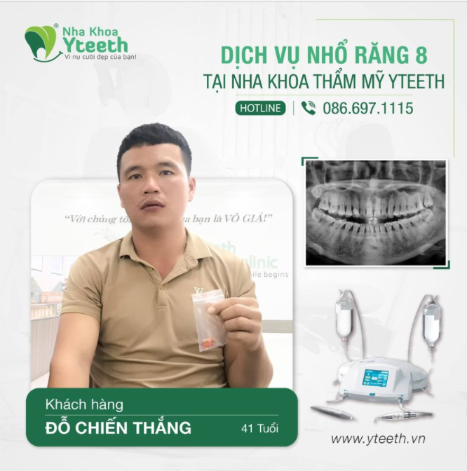 Nhổ răng khôn nhẹ nhàng thế này biết vậy nhổ sớm đỡ phải chịu đau" lời chia sẻ của anh Thắng 41 tuổi sau khi nhổ 2 chiếc răng 8