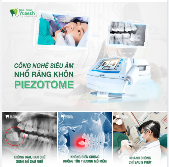 NHỔ RĂNG KHÔN ( RĂNG SỐ 8 ) NHANH CHÓNG- KHÔNG ĐAU- KHÔNG SƯNG CÔNG NGHỆ PIEZOTOME HIỆN ĐẠI- NHỔ RĂNG SAU 5 PHÚT