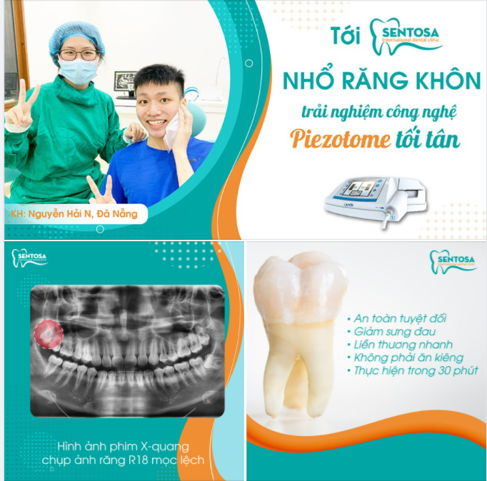 Nhổ răng khôn siêu nhẹ nhàng