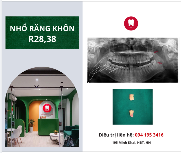 NHỔ RĂNG KHÔN từng là ÁC MỘNG của rất nhiều người CHO ĐẾN KHI..
