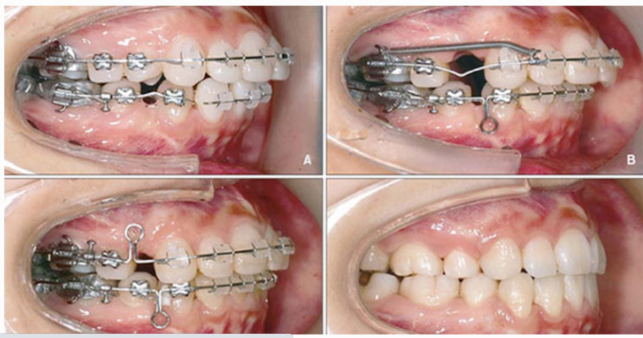 Những điều cần nhớ khi niềng răng để có hàm răng đẹp