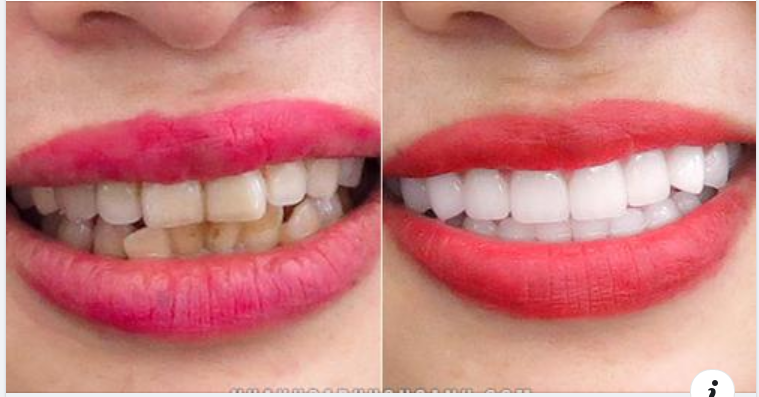 Những lưu ý sau khi làm răng sứ thẩm mỹ