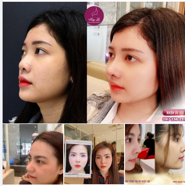 Những pha xử lý MÍ HƯ - MŨI HỎNG tại Hiệp Lợi