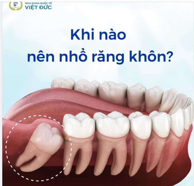 NHỮNG TRƯỜNG HỢP CẦN NHỔ RĂNG KHÔN