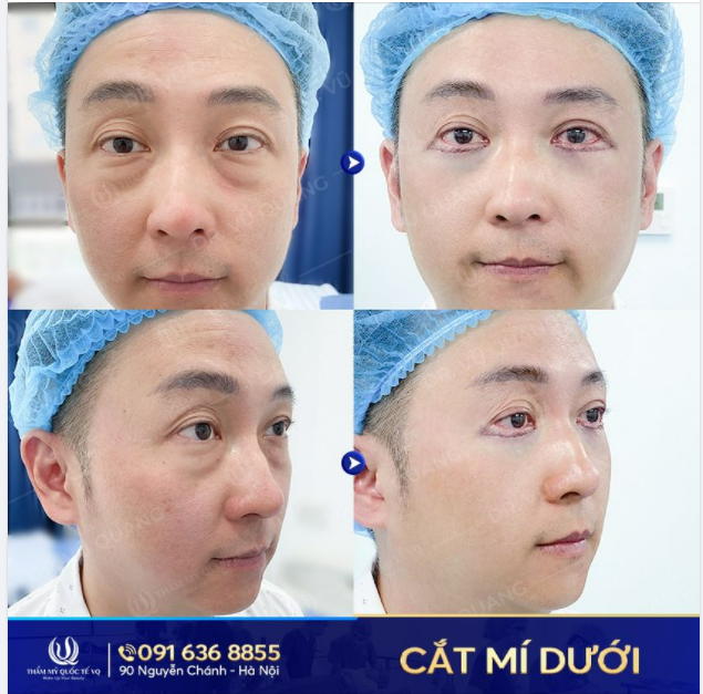 Những trường hợp nào nên cắt mí dưới