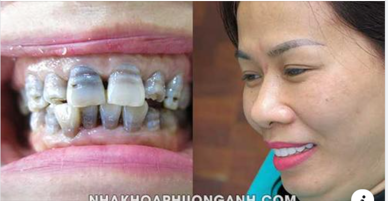 Những yếu tố ảnh hưởng đến độ bền và thẩm mỹ của răng sứ