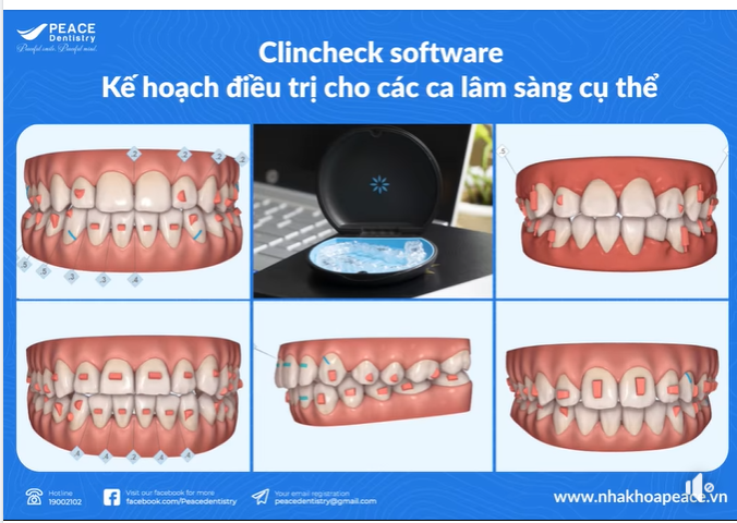 NIỀNG RĂNG BIẾT TRƯỚC KẾT QUẢ VỚI PHẦN MỀM CLINCHECK ĐỘC QUYỀN TỪ INVISALIGN