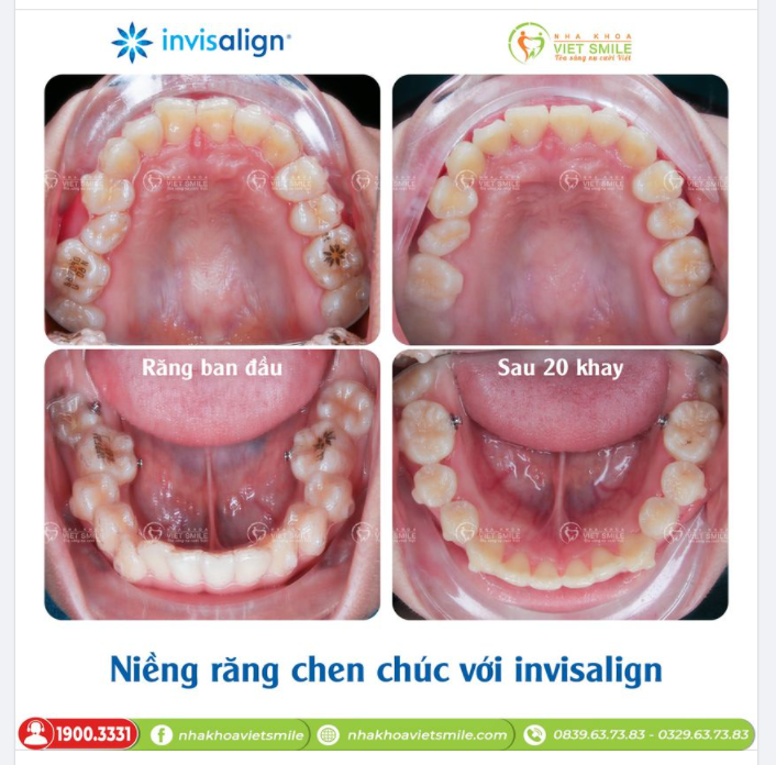 NIỀNG RĂNG CHEN CHÚC, KHẤP KHỂNH VỚI INVISALIGN