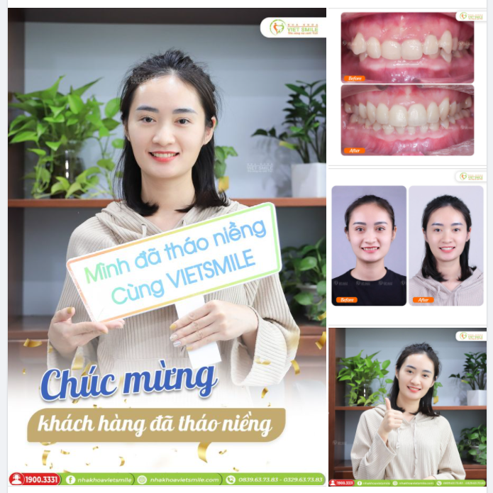 NIỀNG RĂNG CHEN CHÚC, KHỚP CẮN SÂU SAU 2,5 NĂM