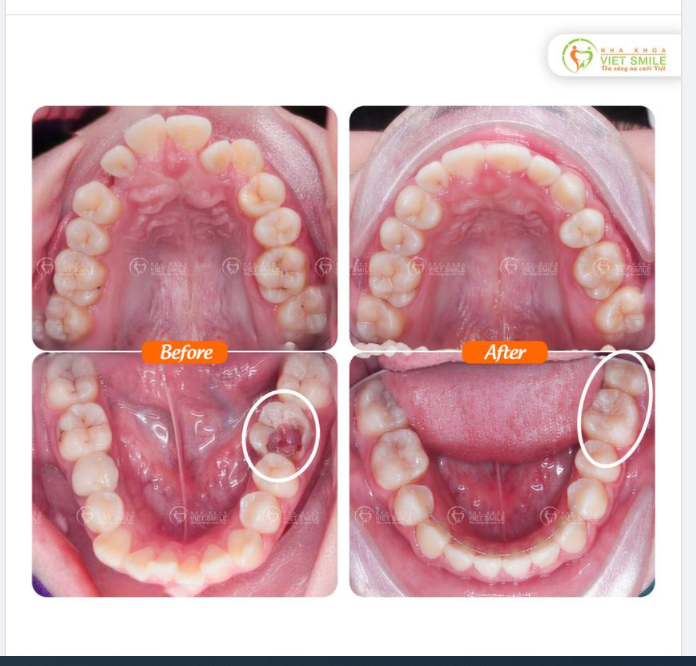 NIỀNG RĂNG CHEN CHÚC NẶNG KẾT HỢP KÉO RĂNG 8 THAY RĂNG 6 SÂU HỎNG