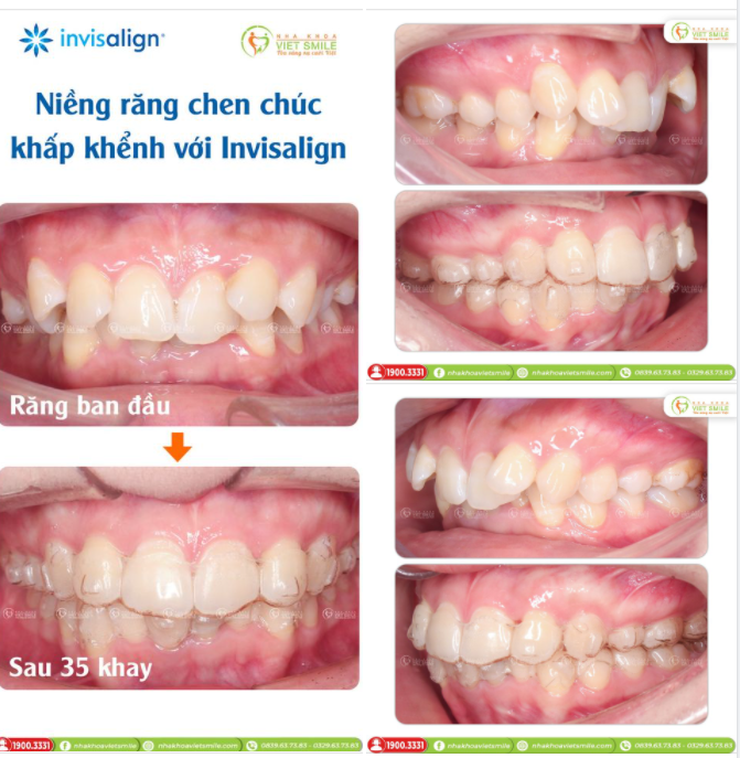NIỀNG RĂNG CHEN CHÚC, KHẤP KHỂNH VỚI INVISALIGN