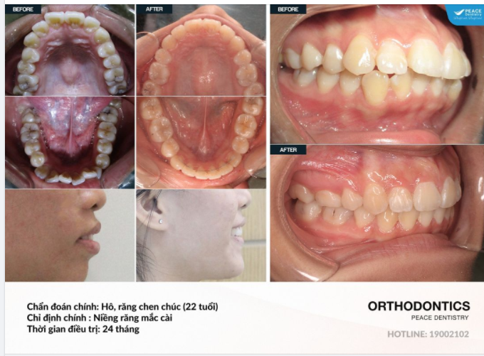 NIỀNG RĂNG CHỈNH HÔ: Giải đáp những câu hỏi phổ biến nhất