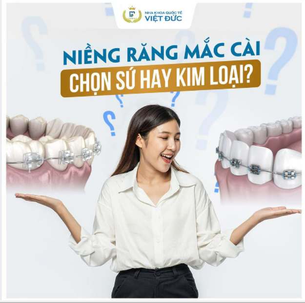 NIỀNG RĂNG CHỌN MẮC CÀI SỨ HAY KIM LOẠI