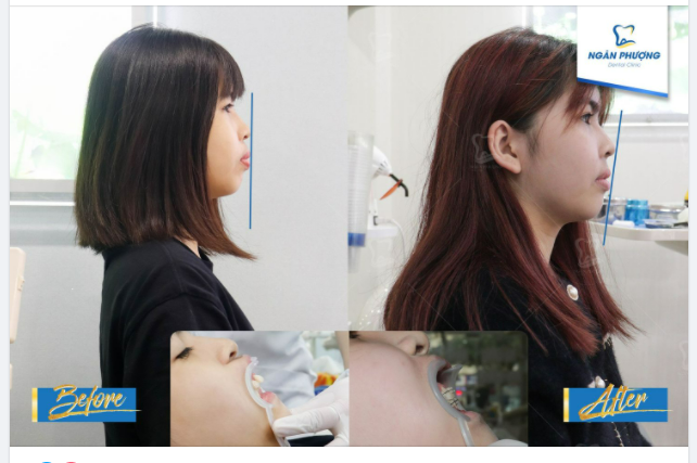 NIỀNG RĂNG CÓ THAY ĐỔI ĐƯỢC GÓC NGHIÊNG KHÔNG