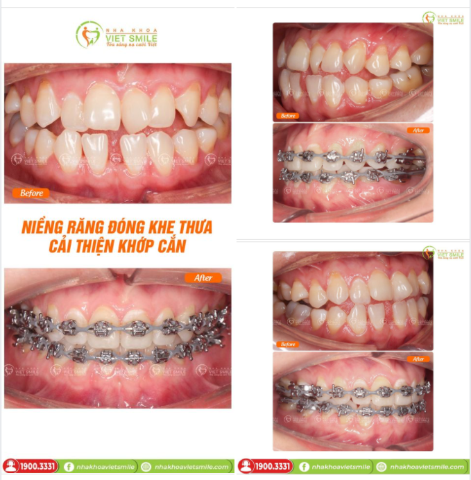 NIỀNG RĂNG ĐÓNG KHE THƯA, CẢI THIỆN KHỚP CẮN