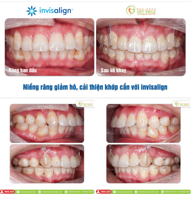 NIỀNG RĂNG GIẢM HÔ, CẢI THIỆN KHỚP CẮN VỚI INVISALIGN