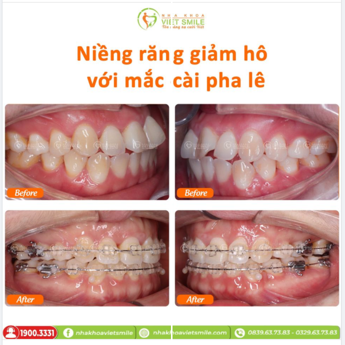 NIỀNG RĂNG GIẢM HÔ VỚI MẮC CÀI PHA LÊ
