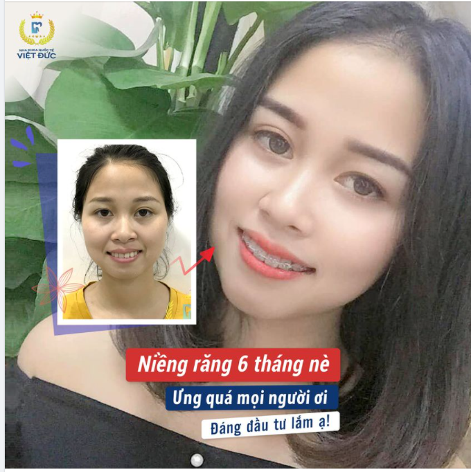NIỀNG RĂNG HẠNH PHÚC NHẤT LÀ THẤY RĂNG THAY ĐỔI TỪNG NGÀY