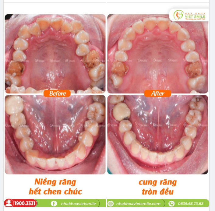 NIỀNG RĂNG HẾT CHEN CHÚC, CUNG RĂNG TRÒN ĐỀU SAU HƠN 2 NĂM