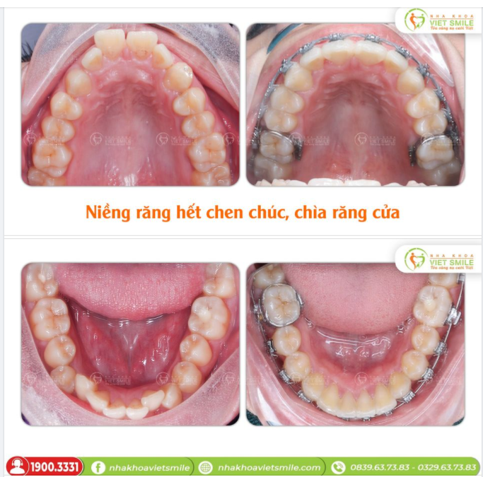 NIỀNG RĂNG HẾT CHEN CHÚC, GIẢM CHÌA RĂNG CỬA