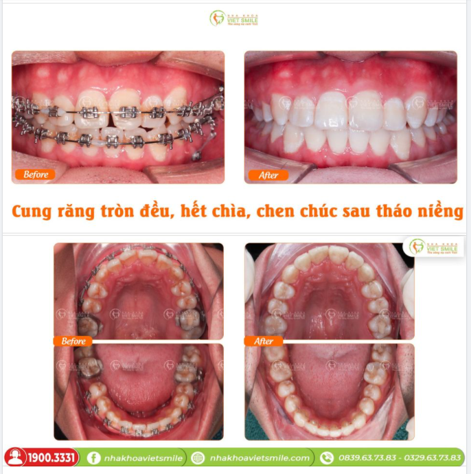 NIỀNG RĂNG HẾT HÔ CHÌA, CUNG RĂNG TRÒN ĐỀU