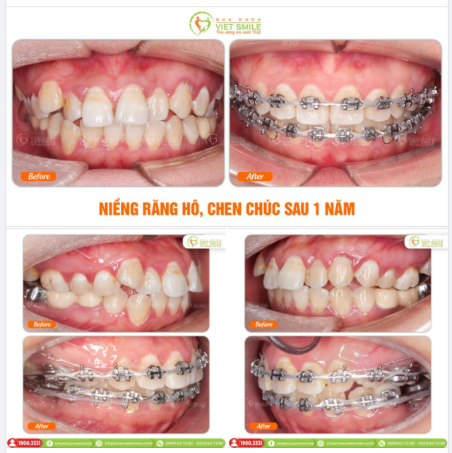NIỀNG RĂNG HÔ, CHEN CHÚC SAU 1 NĂM