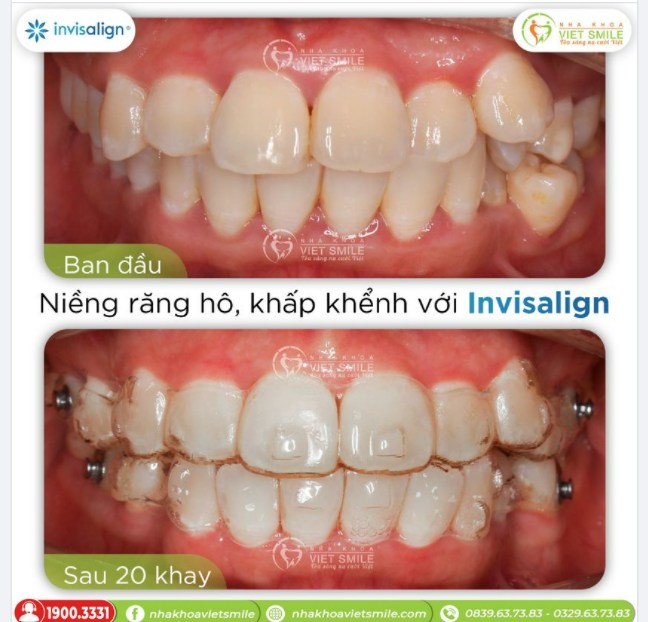 NIỀNG RĂNG HÔ, KHẤP KHỂNH VỚI INVISALIGN