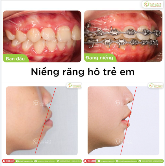 NIỀNG RĂNG HÔ TRẺ EM CÓ THAY ĐỔI GÓC NGHIÊNG