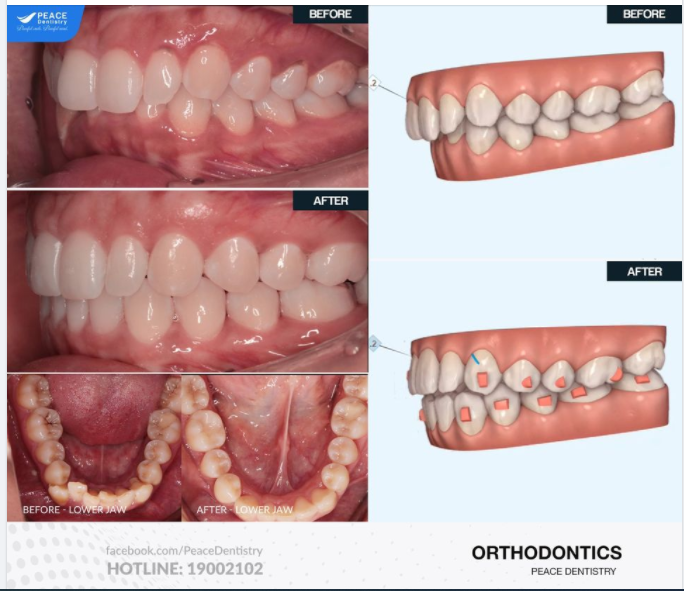 Niềng răng Invisalign cho khách hàng nữ 30 tuổi