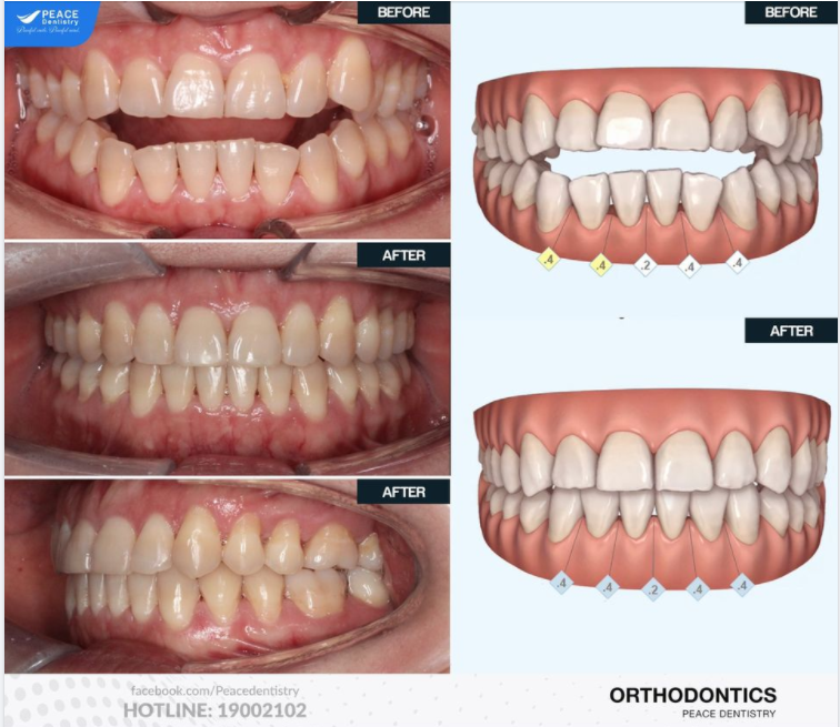 Niềng răng Invisalign cho khách hàng nữ 41 tuổi