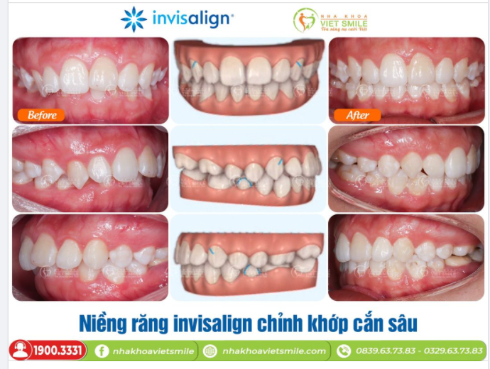 NIỀNG RĂNG INVISALIGN KHẮC PHỤC KHỚP CẮN SÂU