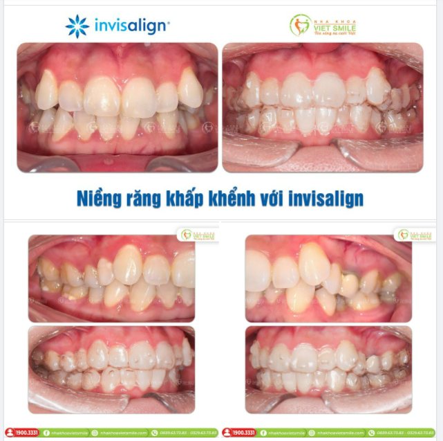 NIỀNG RĂNG INVISALIGN - KHẮC PHỤC RĂNG KHẤP KHỂNH