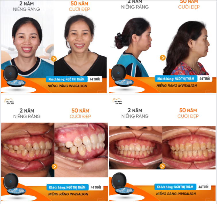 NIỀNG RĂNG INVISALIGN KHÔNG GIỚI HẠN ĐỘ TUỔI