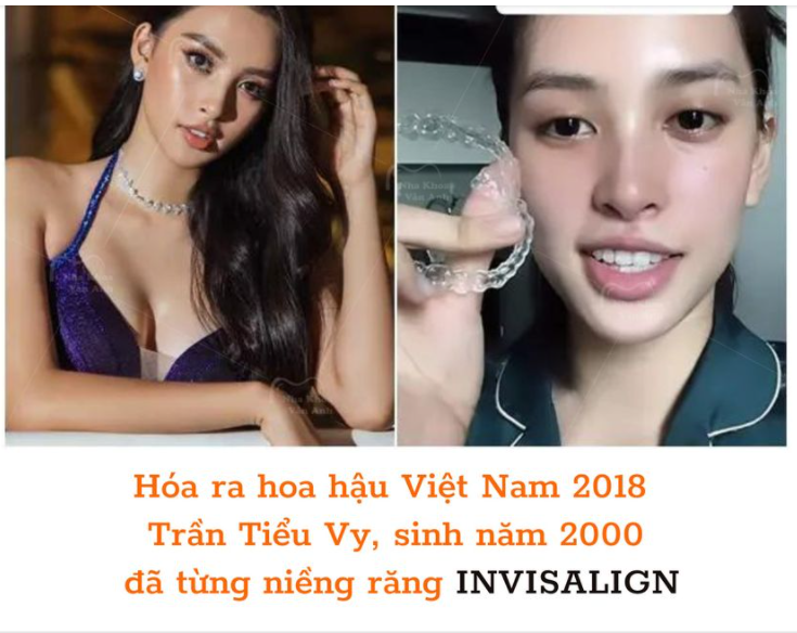 NIỀNG RĂNG INVISALIGN - XINH NHƯ HOA HẬU LÀ CÓ THẬT