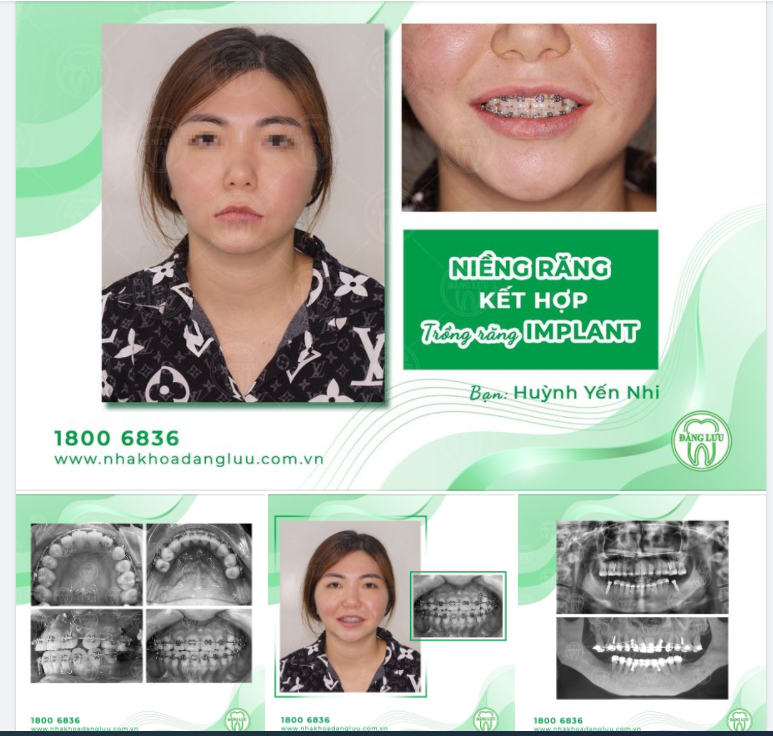 NIỀNG RĂNG KẾT HỢP TRỒNG RĂNG IMPLANT!