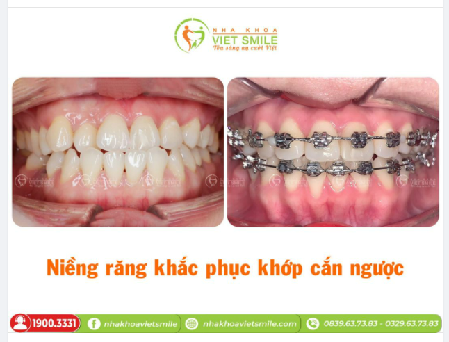 NIỀNG RĂNG KHẮC PHỤC TÌNH TRẠNG KHỚP CẮN NGƯỢC