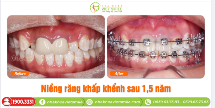 NIỀNG RĂNG KHẤP KHỂNH SAU 1,5 NĂM
