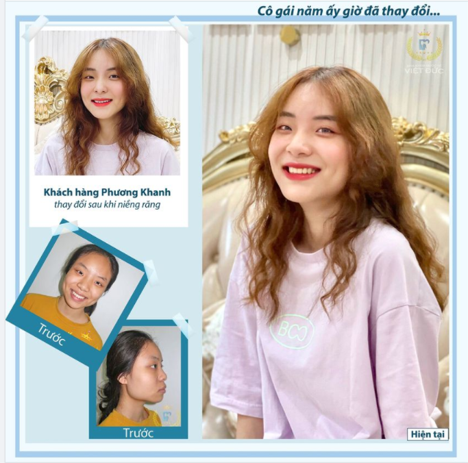 NIỀNG RĂNG KHÔNG KHÓ  NIỀNG RĂNG THAY ĐỔI CẢ GƯƠNG MẶT MỚI KHÓ