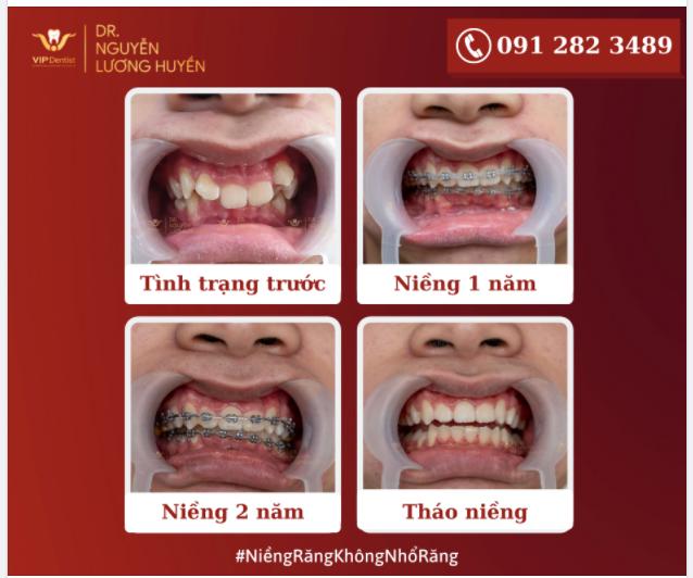 NIỀNG RĂNG KHÔNG NHỔ - ĐỘC QUYỀN VIP DENTIST
