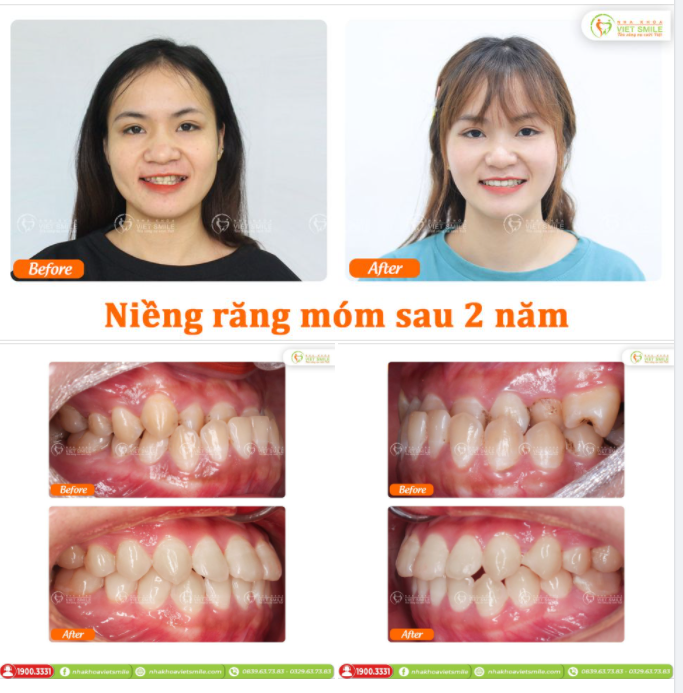 NIỀNG RĂNG KHỚP CẮN NGƯỢC SAU 2 NĂM