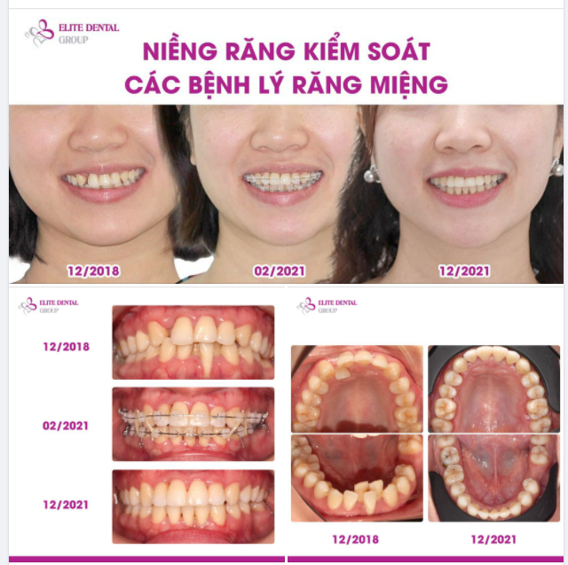 NIỀNG RĂNG KIỂM SOÁT CÁC BỆNH LÝ RĂNG MIỆNG