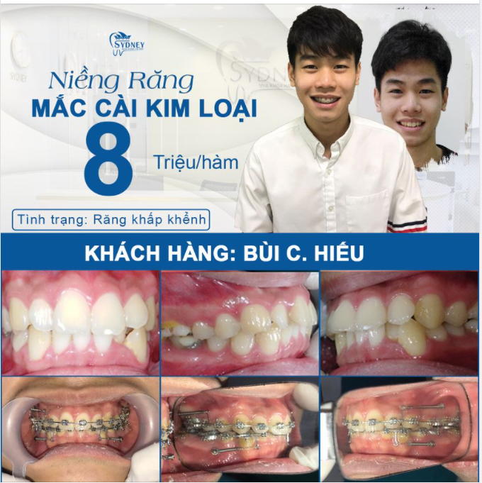 NIỀNG RĂNG KIM LOẠI HIỆU QUẢ NHƯ THẾ NÀO